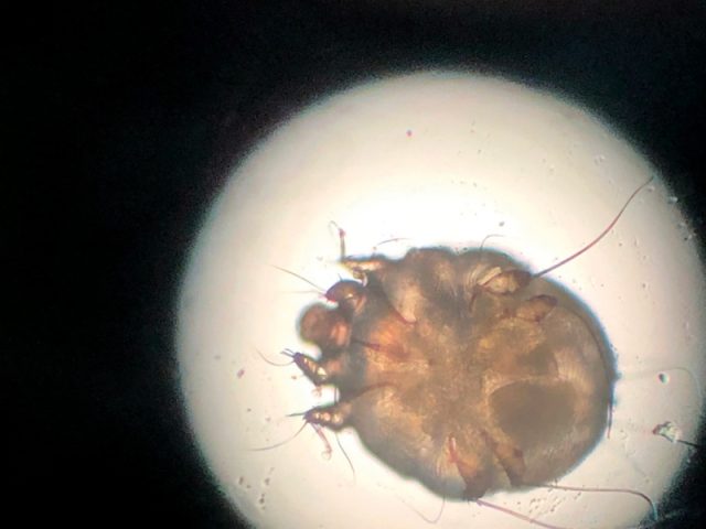 Soi dưới kính hiển vi hình ảnh ve ghẻ Sarcoptes đang đào hầm dưới da