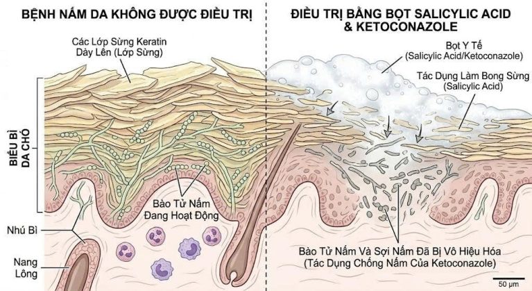 Hoạt chất bạt sừng trong sữa tắm y khoa giúp bào mòn lớp biểu bì chết, mở đường cho thuốc kháng nấm tiêu diệt bào tử ẩn nấp bên dưới.