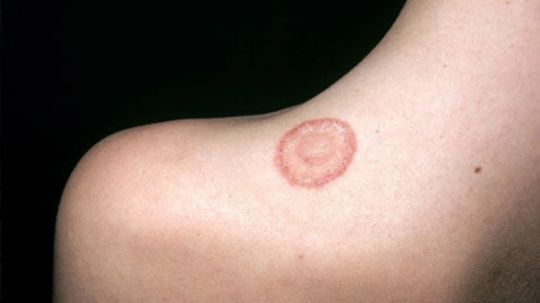 Dấu hiệu hắc lào lây từ mèo trên cánh tay người có viền đồng xu nổi gờ