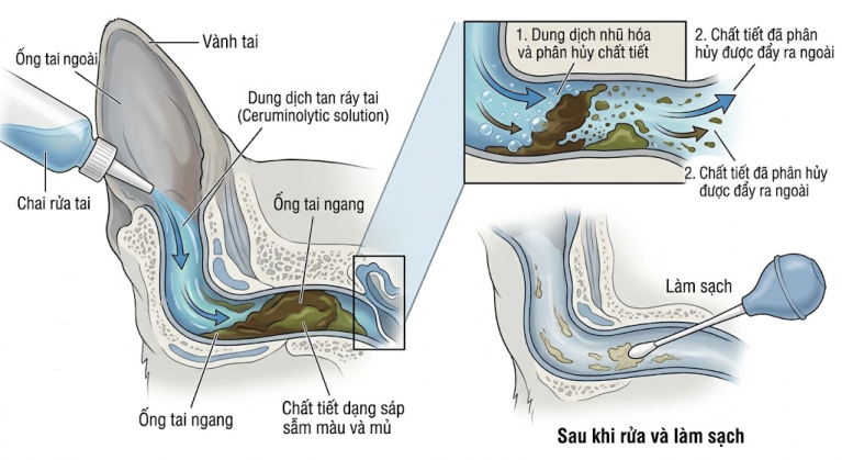 Sơ đồ cơ chế dung dịch tan sáp phá vỡ ráy tai và mủ viêm.