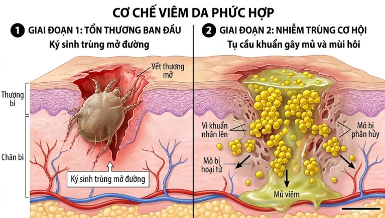 Cơ chế vi khuẩn tụ cầu xâm nhập vào vết xước do ghẻ cào gãi, gây ra dịch mủ và mùi hôi thối.