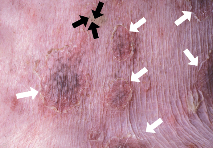 Hình ảnh lâm sàng vòng vảy tiết và mụn mủ trên da chó bị viêm da mủ nông