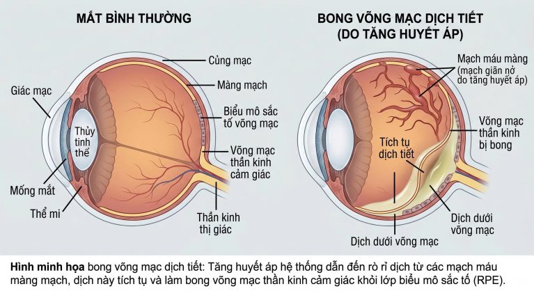 Sơ đồ cơ chế bong võng mạc ở chó mèo do tăng huyết áp đẩy dịch mủ làm tách rời lớp màng thần kinh.