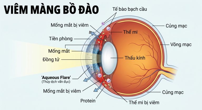 Sơ đồ cơ chế viêm màng bồ đào, mô tả sự phá vỡ hàng rào máu khiến protein và tế bào viêm tràn vào thủy dịch.