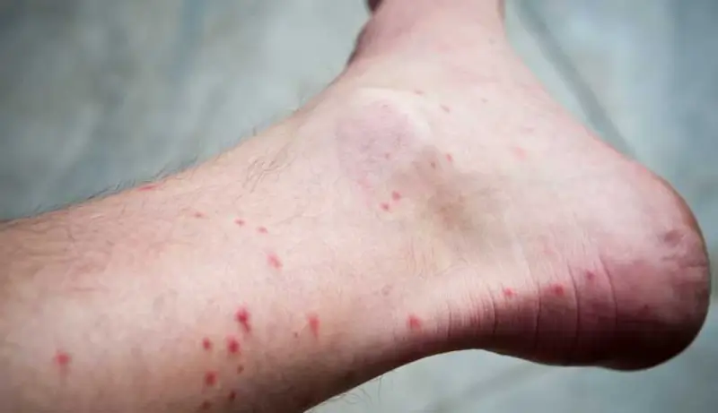 Các nốt đỏ ở cổ chân gợi ý tình trạng côn trùng đốt